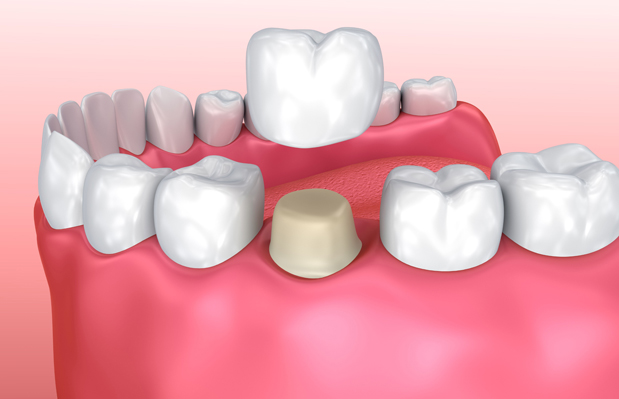 Why Are Dental Crowns Needed